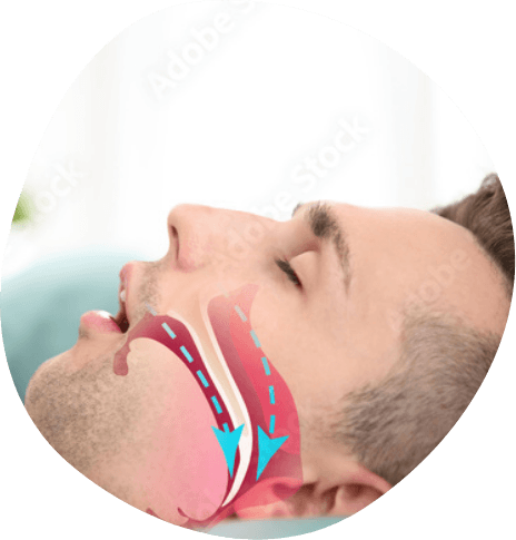 Side profile of sleeping man showing illustration of blocked airway