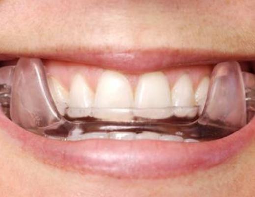 Close up of mouth with oral appliance over the upper teeth